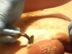 Pre-catheter shave. Part two