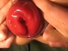 anal prolapse from dildo pump extreme